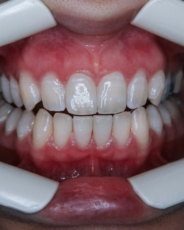 Teeth at Mobecca