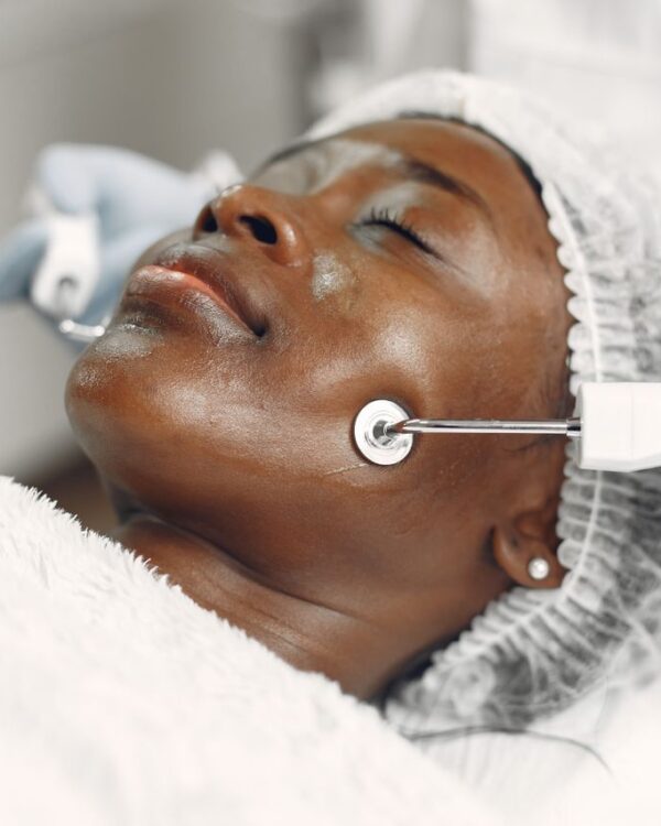 Micro Needling treatment at Mobecca