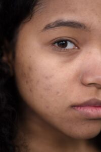 Best Actives for Hyperpigmentation on Melanin-Rich Skin
